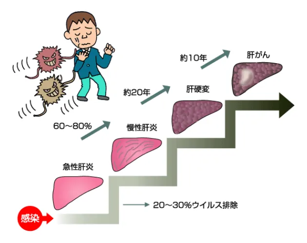 C型慢性肝炎